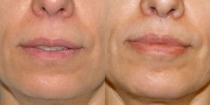 London Lip Lift Before and after photos by LBPS