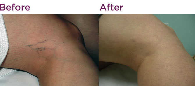 Before & After varicose vein treatment