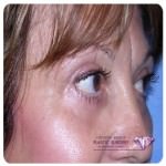 Eyelid Plastic Surgery