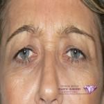 Eyelid Plastic Surgery