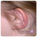 Prominent Ear Correction