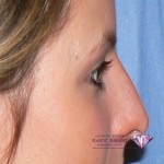 Rhinoplasty Nose Reshaping