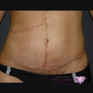 Scarring and Scar Revision