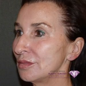 Silhouette Face Lift