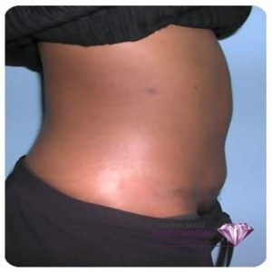 Abdominoplasty / Tummy Tuck
