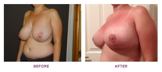 Before and After Breast Reduction SurgeryBefore and After Breast Reduction Surgery