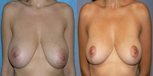 Breast Reduction by London plastic surgeon Dr. Inglefield