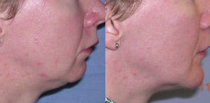 Chin Implant before and after photo in London by Dr. Inglefield