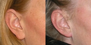 Earlobe Repair Before and after photos in London by Dr. Inglefield