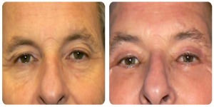 Eyelid Surgery before and after photo in London by Dr. Inglefield