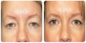 Eyelid Surgery before and after photo in London by Dr. Inglefield