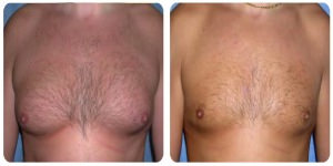 Male Breast Reduction in London before and after photos