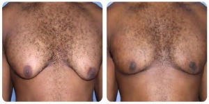 Male Breast Reduction in London before and after photos