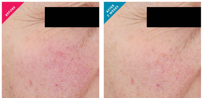 Rosacea before and after treatment
