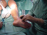 Endoscopic varicose vein removal