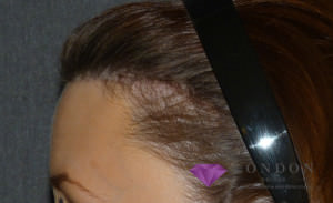Hairline Lowering