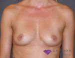 B-Lite Breast Implant Surgery