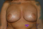 B-Lite Breast Implant Surgery