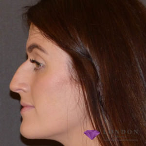 Rhinoplasty before and after photo by Dr. Inglefield in London