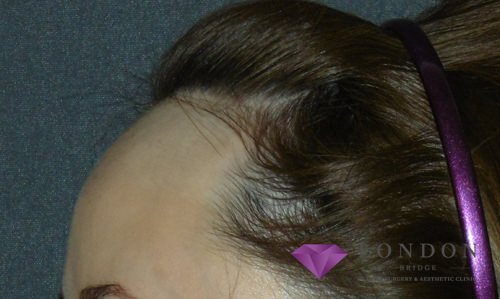 Hairline lowering before and after photo in London by Dr. Inglefield