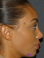Rhinoplasty Nose Reshaping