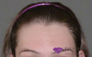 Hair Line Lowering Pre Surgery