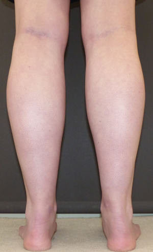 Calf Augmentation Before and After Results