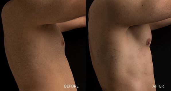 High Definition Liposuction Before & After Photo in London by LBPS